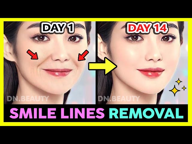 ✨ SMILE LINES (LAUGH LINES) REMOVAL AND FILL WITH KOREAN FACE EXERCISE & MASSAGE IN 2 WEEKS