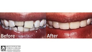 Straighten Your Front Teeth In One Day