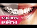 Элайнеры или брекеты что лучше?