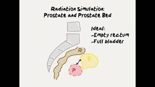 Doctor Explains Prostate Cancer Radiation Simulation Procedure - Patient Instructions