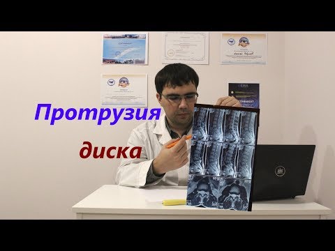 Протрузия диска: что это такое, как лечить протрузию?