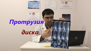 Протрузия диска: что это такое, как лечить протрузию?