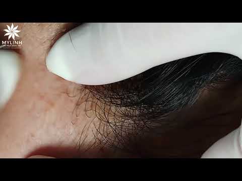 BLACKHEADS AND ACNE REMOVAL #38 | Lấy mụn ẩn dưới da, mụn đầu đen | 黑頭和粉刺去除 | 0934000075