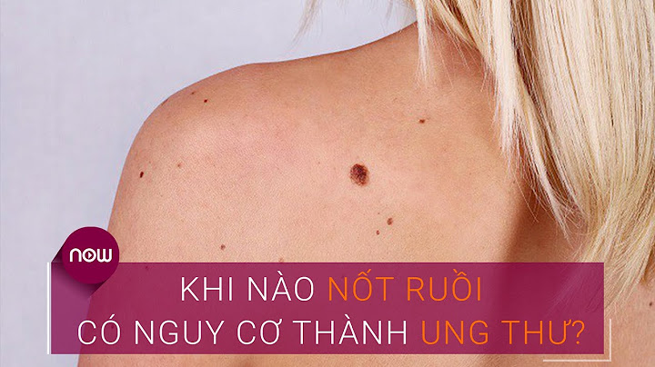 Nốt ruồi đỏ mọc nhiều là dấu hiệu bệnh gì