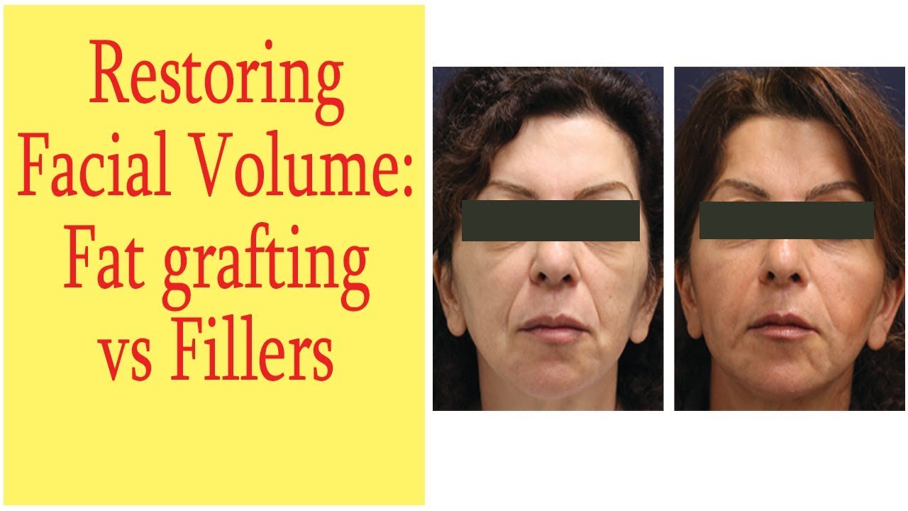 Fat Transfer Vs. Fillers To Restore Facial Volume The Esthetic