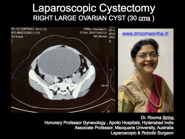 Dr Rooma Sinha Postmenopausal Uterine Bleeding Reasons For dr-rooma-sinha-postmenopausal-uterine-bleeding-reasons-for