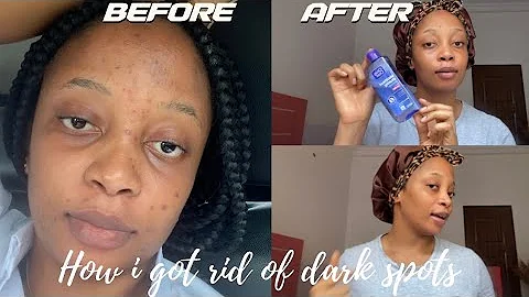 How I Cleared My Acne + Dark Spots + Hyperpigmentation for good in 1 month (NO ACCUTANE) VIDEO PROOF