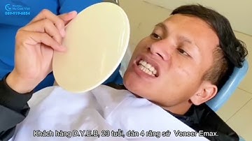 DÁN SỨ  VENEER TẠI NỤ CƯỜI VIỆT - BẢO TỒN RĂNG GỐC, MÀU ĐẸP TỰ NHIÊN