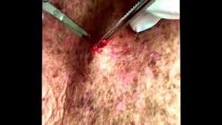 Another method to pop out a cyst. For medical education- NSFE.