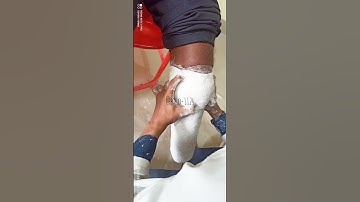 CASTING PROCEDURE OF TRANSTIBIAL AMPUTATION FOR MAKING PTB  PROSTHESIS.