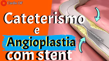 Como é feito a colocação de stent?