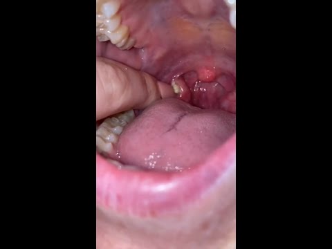 لا تستخدم أصابعك لإزالة حصى اللوزتين تعر ف على الطريقة الصحيحة لتجنب الالتهابات