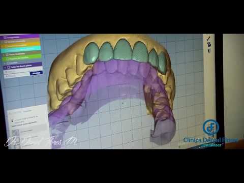 CLÍNICA DENTAL FLORES - TECNOLOGÍA CAD - CAM