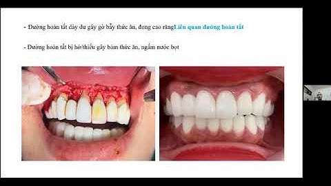 Viêm lợi do răng sứ(thầy Khánh)