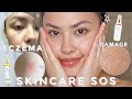 My Current and Best Skincare Tips I'm Currently Doing | *eczema, bites, and dry, itchy skin*