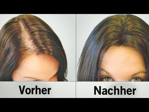 Video: Was Tun, Wenn Die Haare Auf Ihrem Kopf Schnell Ausfallen?