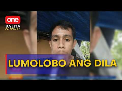 28-anyos na lalaki sa Sorsogon, lumolobo ang dila dahil sa hemangioma | One Balita Pilipinas
