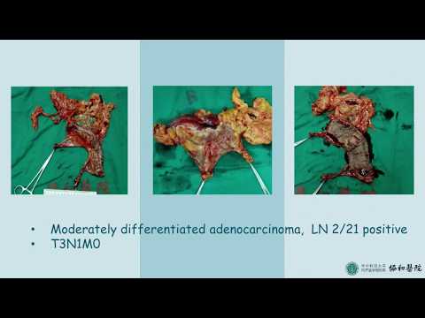 STARR for Rectocele after Endoscopic Mucosal Resection. 
