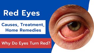 Red Eyes: Causes, Treatment and Home Remedies | Effective Home Remedies For Red Eyes