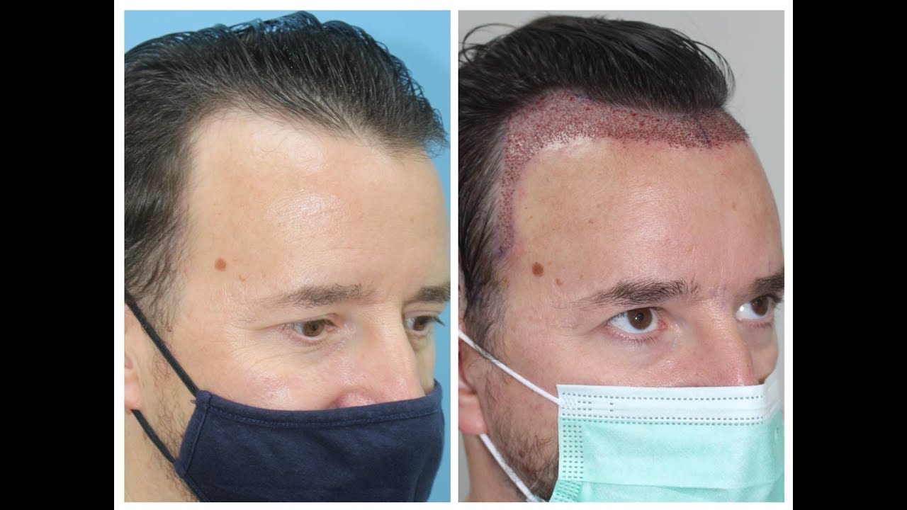 DHT Hair Clinic Bangkok Review (SouthEast Asia Transplant Experience) YouTube