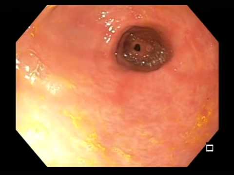 Bile Reflux Gastritis