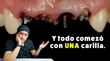 ¿Las personas con carillas tienen caries?