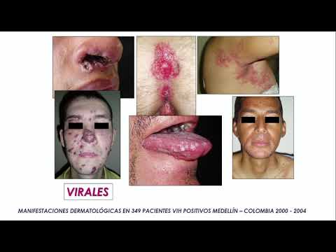 Video: Erupciones Y Afecciones De La Piel Asociadas With The VIH Y El SIDA