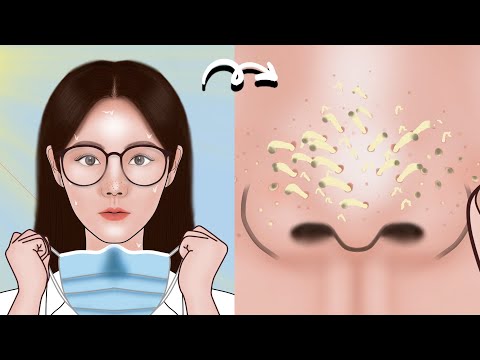 Satisfying Full Blackhead Treatment At Home! ASMR skincare animation丨Meng's Stop Motion