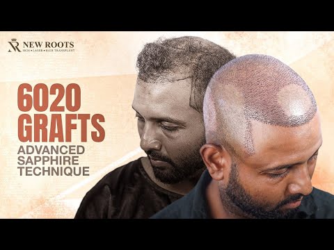 This Is an EXTREME Hair Transplant! 🤯 | 6000 Grafts | Hair Transplant in Bangladesh | New Roots
