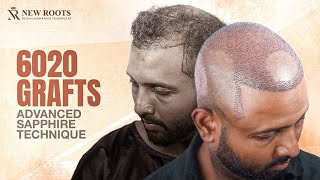 This Is an EXTREME Hair Transplant! 🤯 | 6000 Grafts | Hair Transplant in Bangladesh | New Roots