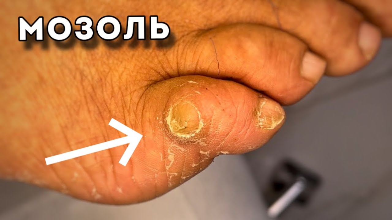 Удаляю МОЗОЛЬ полностью, но растет снова - YouTube