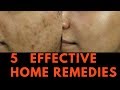 5 EFFECTIVE Home Remedies for Skin Pigmentation, Brown Spots and freckles