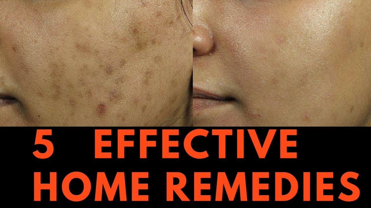 5 EFFECTIVE Home Remedies for Skin Pigmentation, Brown Spots and freckles