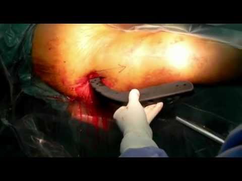 Video: Liječnik Kirurg - Specifičnosti, Recepcija, Vrste Liječenja, Operacije, Dužnosti