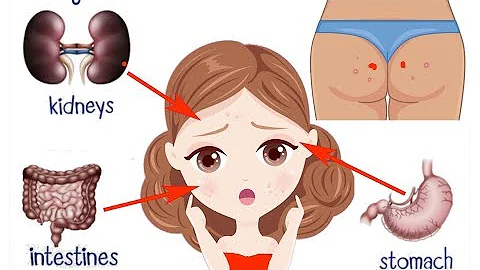 16 Acne Locations and What They Reveal About Your Health - Acne Meaning & Face Mapping Your Pimple - DayDayNews