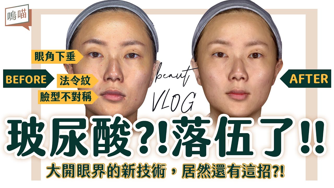 洢蓮絲比玻尿酸CP值更高？！告別鬆垮嘴邊肉，電波拉提外的新選擇，Ellanse效果超群 ft. @Shang Lift上立提  ｜NeKo嗚喵．beauty VLOG