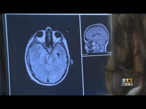 New research finds  people who contract COVID-19 have higher risk of neurological conditions