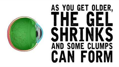 What it Looks Like | Floaters