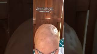 Not So Good Side Effects Of Treatment