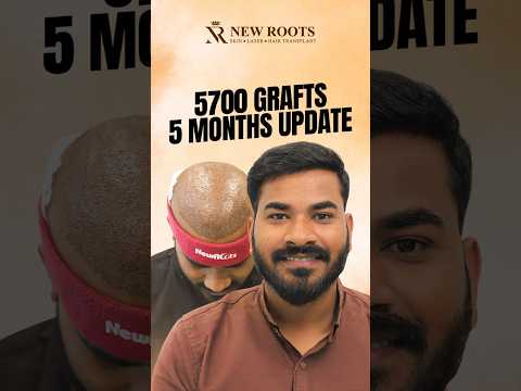 Hair Transplant in Nagpur - 5700 Grafts | Cost and Best Results #hairtransplant #nagpur #shorts
