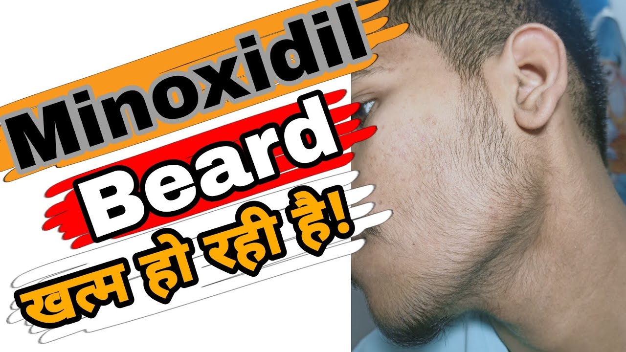 i-lost-my-minoxidil-beard-my-shedding-phase-started-youtube