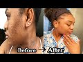 HOW I CLEARED MY ACNE + ACNE SCARS AND GOT CLEAR SKIN IN ONE MONTH! after suffering for 2 years