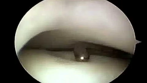 Outcome of Arthroscopic Debridement and Microfract...