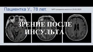 Восстановление зрения после инсульта с применением НейроПорта. Клинический случай. Кутькова А.К.