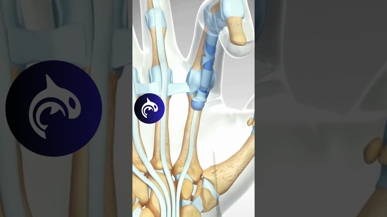 See How A Trigger Finger Is Released 3D Animation Hand Orthopedics