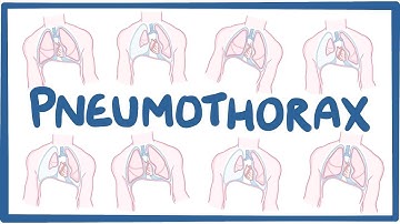 Pneumothorax - causes, symptoms, diagnosis, treatment, pathology