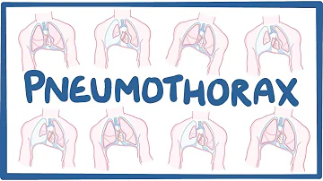 Was wird bei einem Pneumothorax gemacht?
