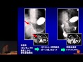 胃がんの薬物療法〜抗がん剤の進歩と最新の治療戦略　坂田 優