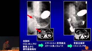 胃がんの薬物療法〜抗がん剤の進歩と最新の治療戦略　坂田 優