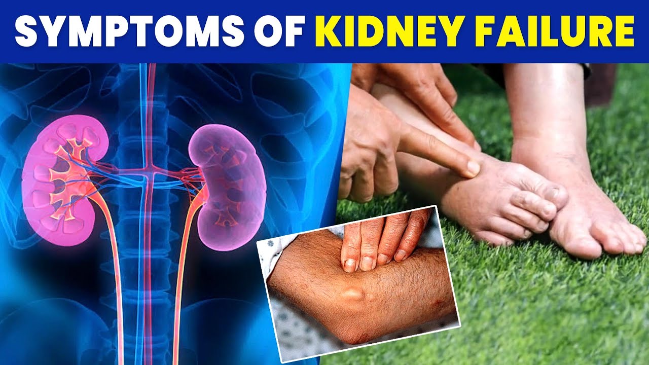 Kidney Failure Symptoms What causes Kidney Failure? YouTube